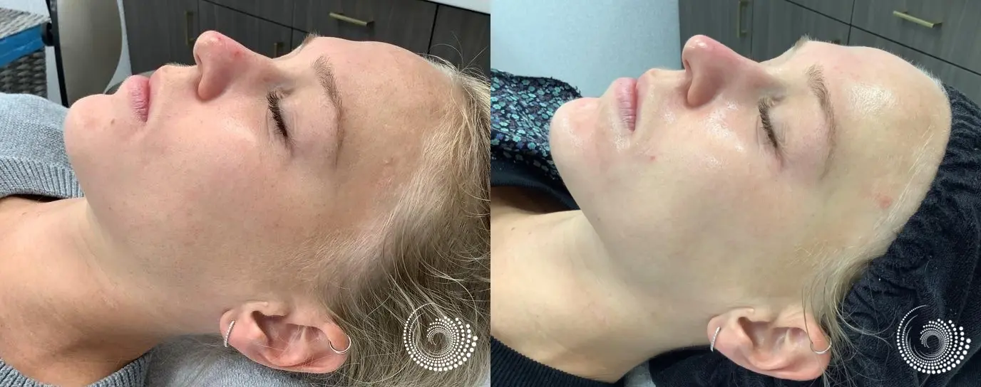 VI Peel to even skin tone and target hyperpigmentation - Before and After 3