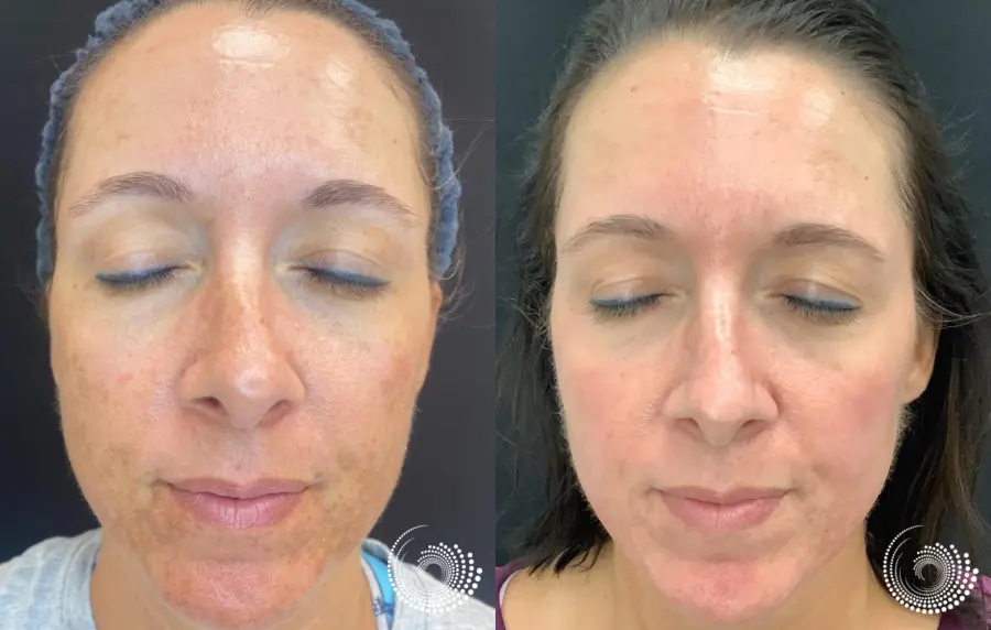 Melanage chemical peel treats melasma - Before and After 2