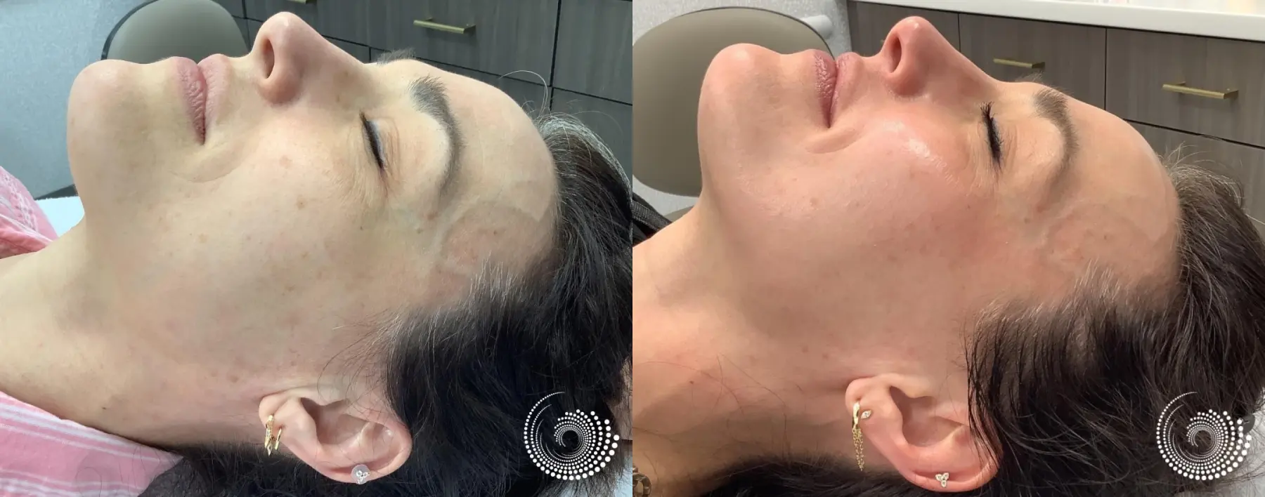 Melanage Mini Peel for dark spots - Before and After 2