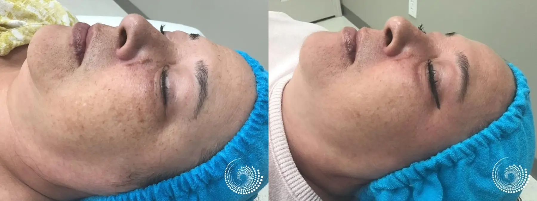 Mini Melanage Peel to reduce hyperpigmentation - Before and After