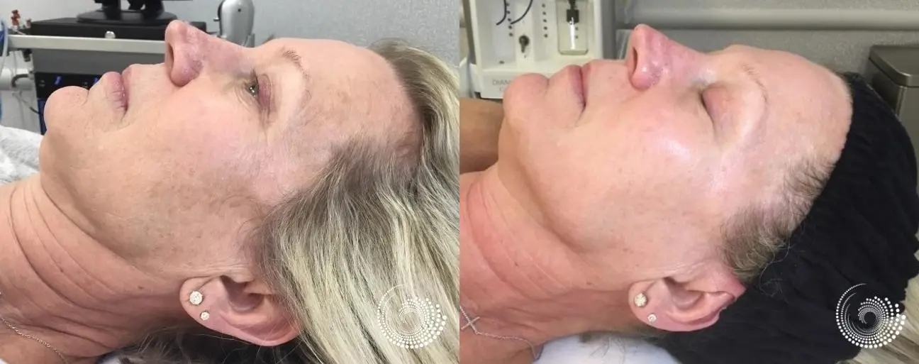 Melanage Mini Peel to even skin tone - Before and After 2