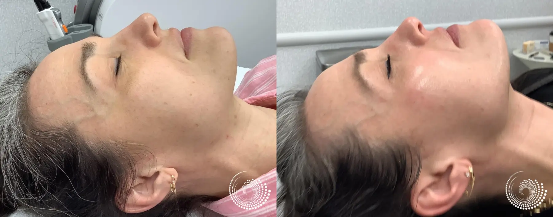 Melanage Mini Peel for dark spots - Before and After 3