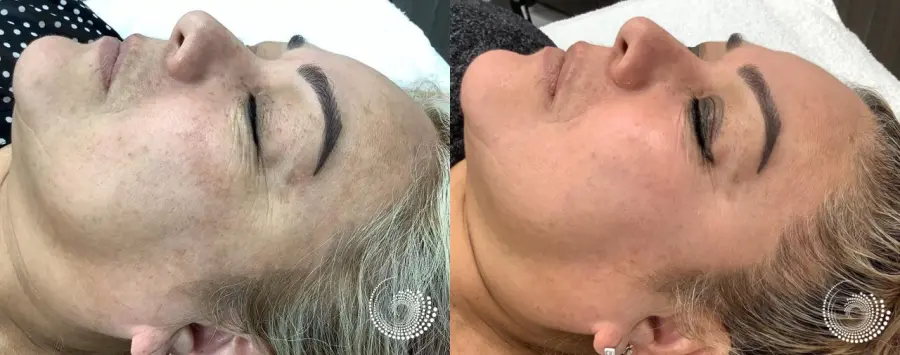 Melanage Mini Peel for dark sun damage - Before and After
