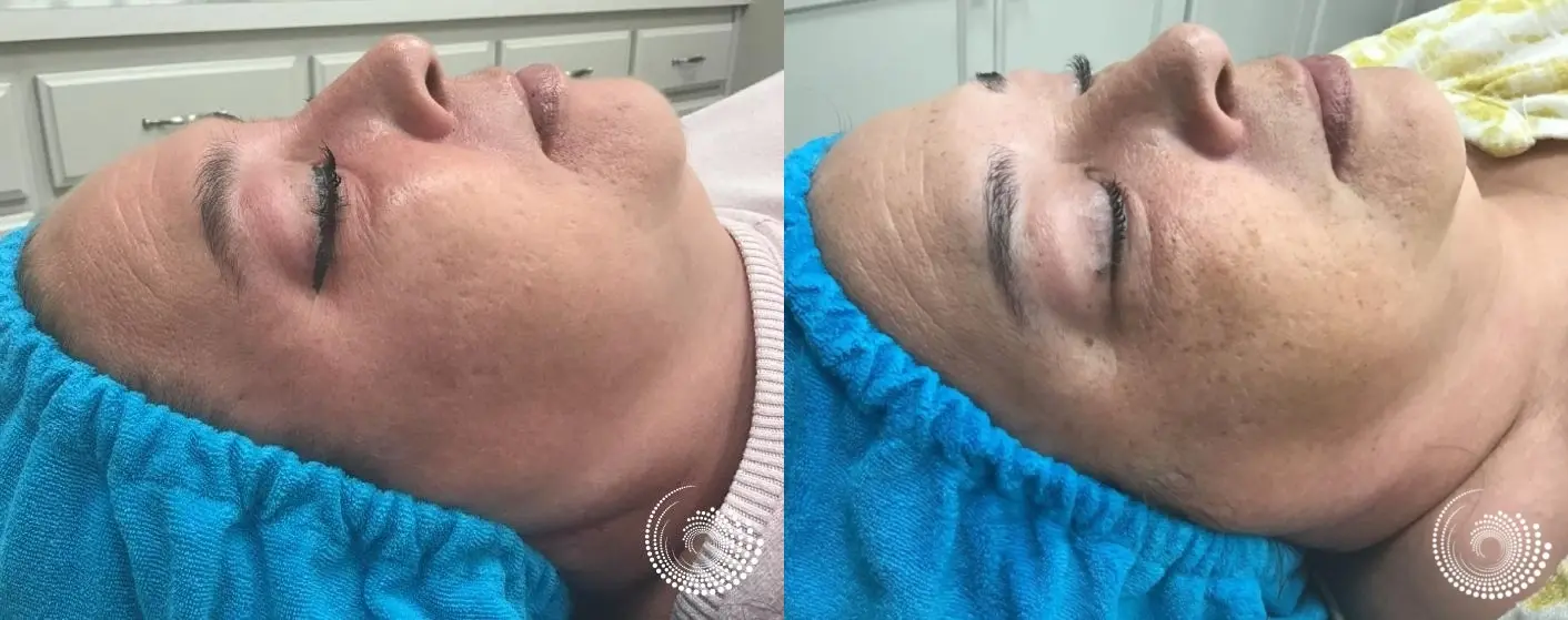 Mini Melanage Peel to reduce hyperpigmentation - Before and After 3