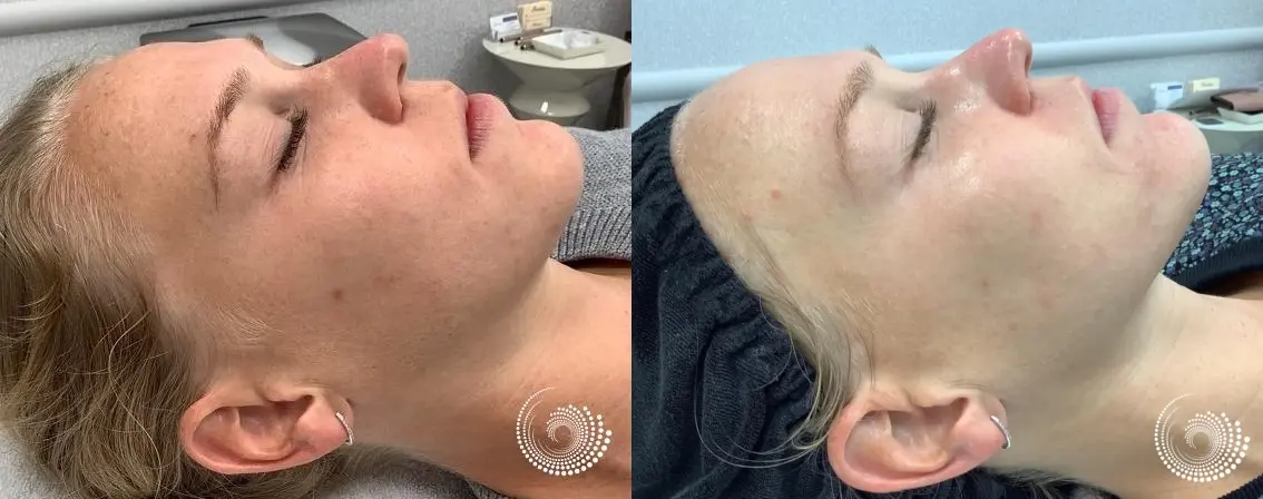 VI Peel to even skin tone and target hyperpigmentation - Before and After 2