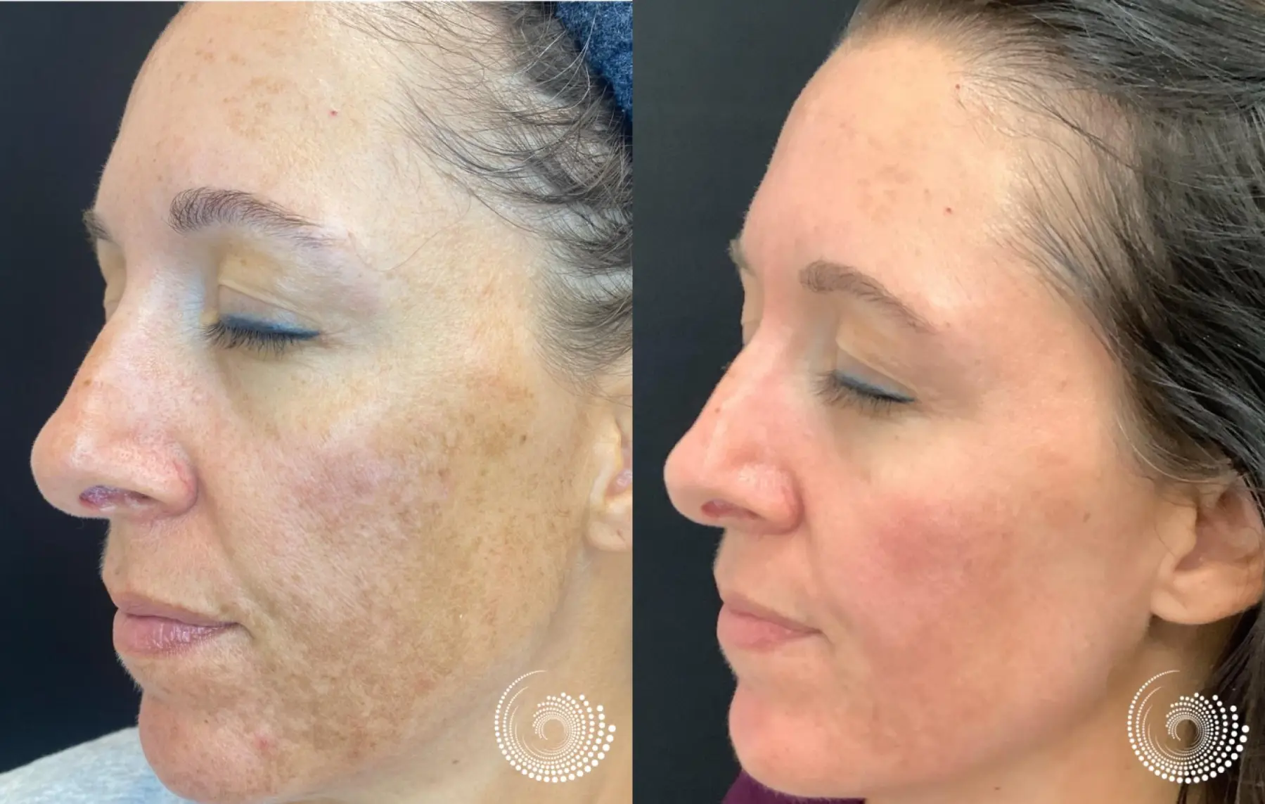 Melanage chemical peel treats melasma - Before and After 1