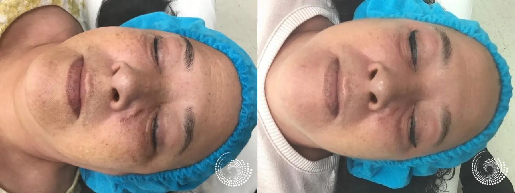 Mini Melanage Peel to reduce hyperpigmentation - Before and After 2