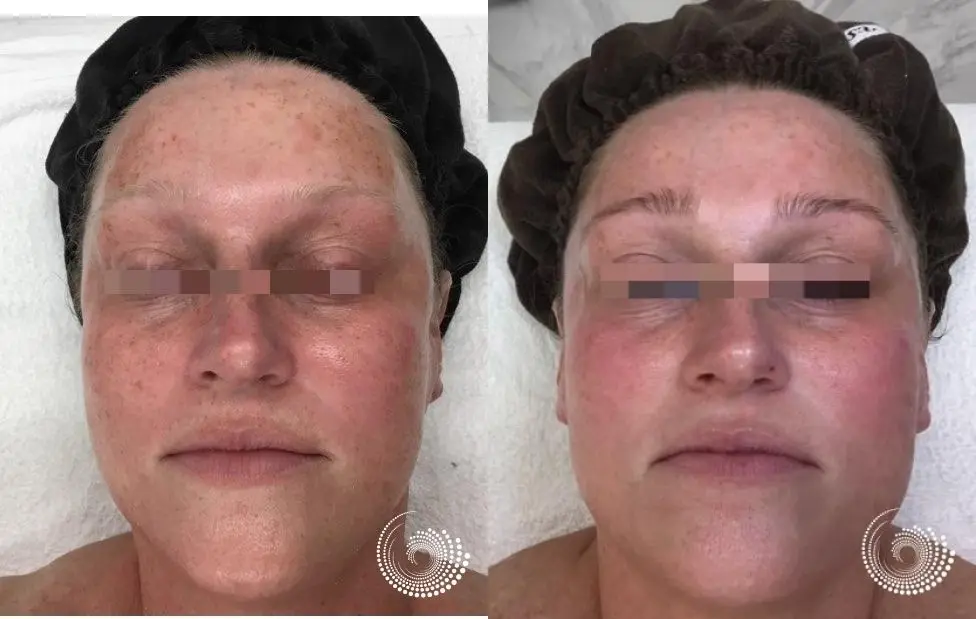 Melanage peel plus weekly Brightening Pads reduces pigmentation - Before and After
