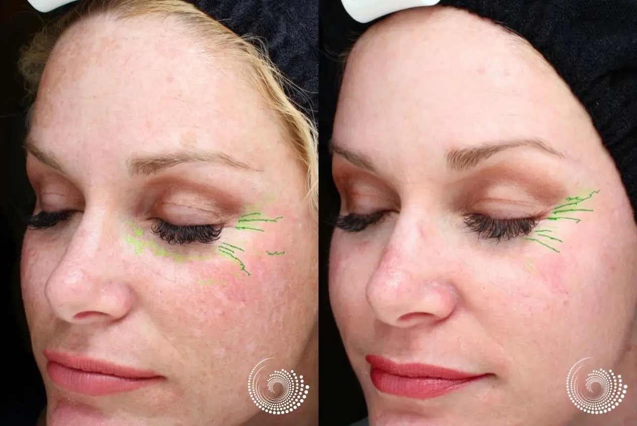 Melanage peel to reduce hyperpigmentation - Before and After 1