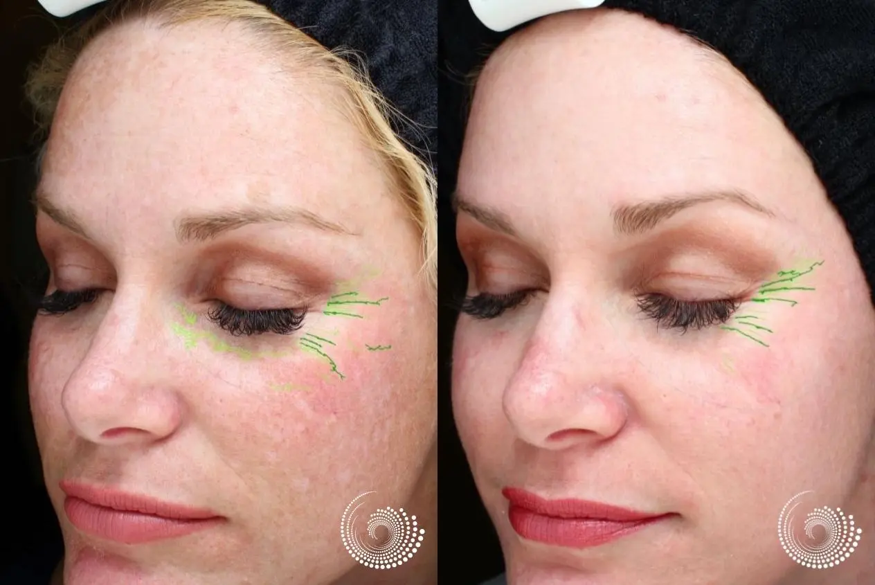 Chemical Peel Before & After