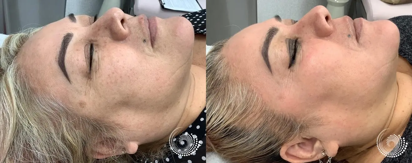 Melanage Mini Peel for dark sun damage - Before and After 3