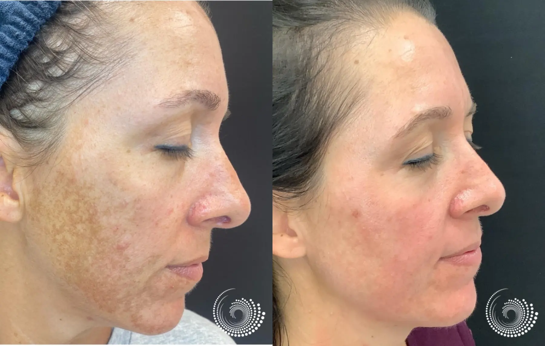 Melanage chemical peel treats melasma - Before and After 3