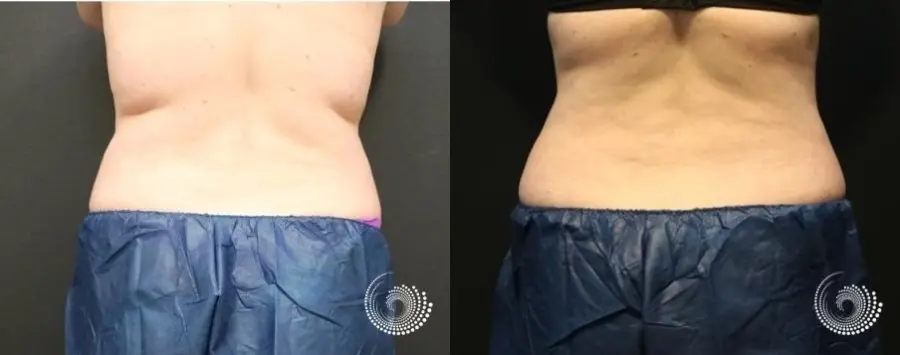 CoolSculpting Elite treatment - fat on flanks - Before and After