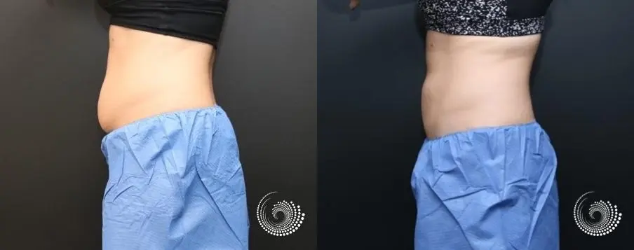 CoolSculpting Elite to reduce fat on abdominals - Before and After 3