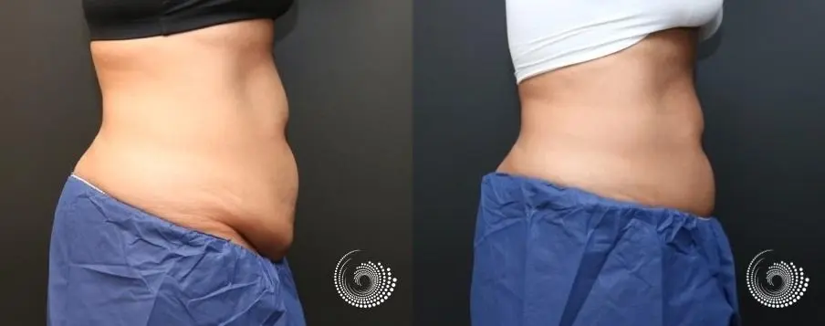 CoolSculpting Elite for her stubborn fat on abs and flanks - Before and After 5