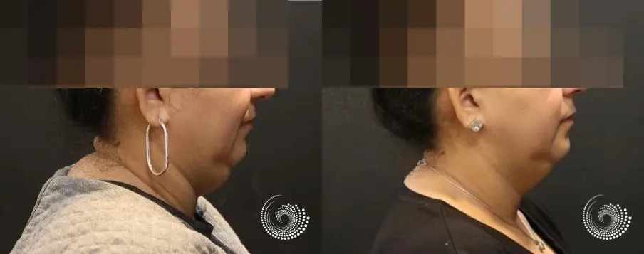 CoolSculpting Elite treats fat under chin - Before and After 2