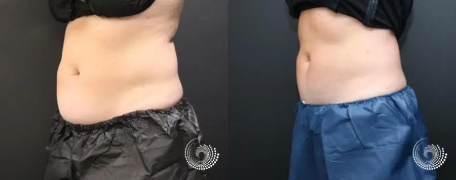 CoolSculpting Elite treatment – stubborn fat in her abdominal area - Before and After 2