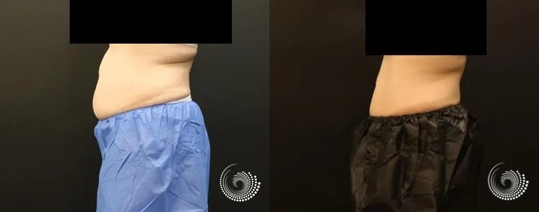 CoolSculpting reduces stubborn fat in abs and flanks - Before and After