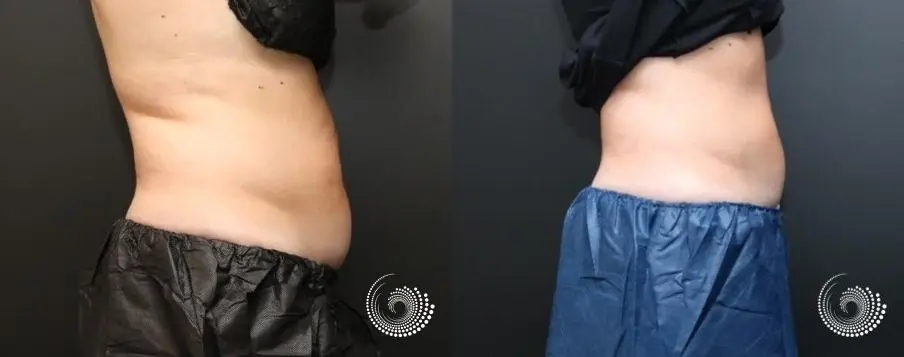 CoolSculpting Elite treatment – stubborn fat in her abdominal area - Before and After 4