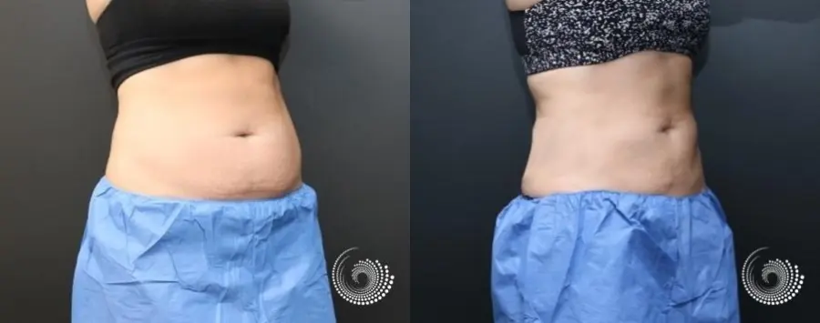 CoolSculpting Elite to reduce fat on abdominals - Before and After 5
