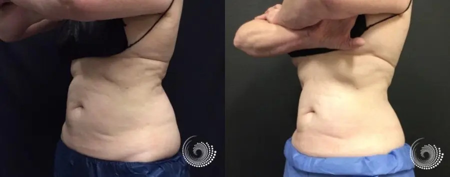 CoolSculpting Elite for stubborn fat on abs and flanks - Before and After 3