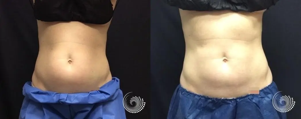 CoolSculpting Elite treatment - fat on abs and flanks - Before and After