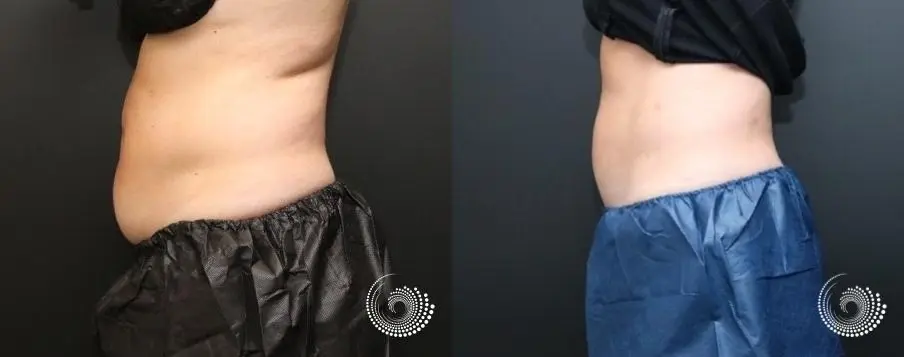 CoolSculpting Elite treatment – stubborn fat in her abdominal area - Before and After