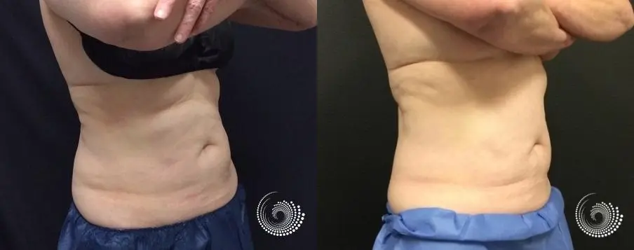 CoolSculpting Elite for stubborn fat on abs and flanks - Before and After 5