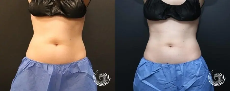 CoolSculpting Elite to reduce fat on abs and flanks - Before and After 3