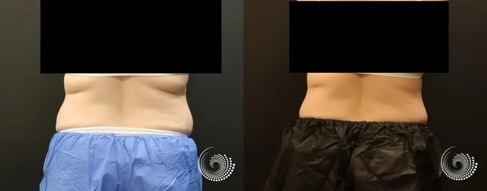CoolSculpting reduces stubborn fat in abs and flanks - Before and After 5