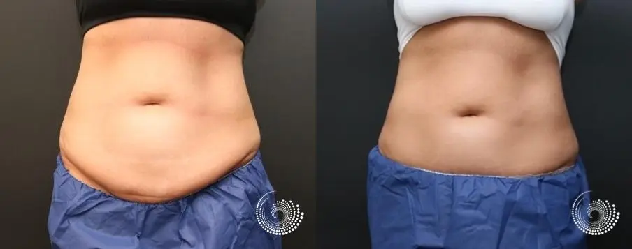 CoolSculpting Elite for her stubborn fat on abs and flanks - Before and After 2