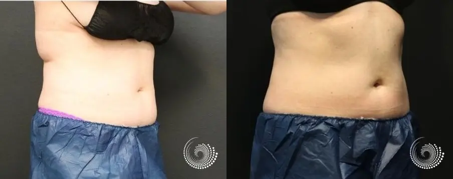 CoolSculpting Elite treatment - fat on flanks - Before and After 3