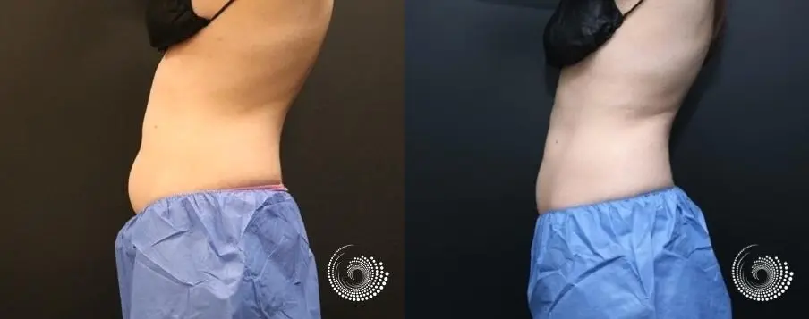 CoolSculpting Elite to reduce fat on abs and flanks - Before and After 4