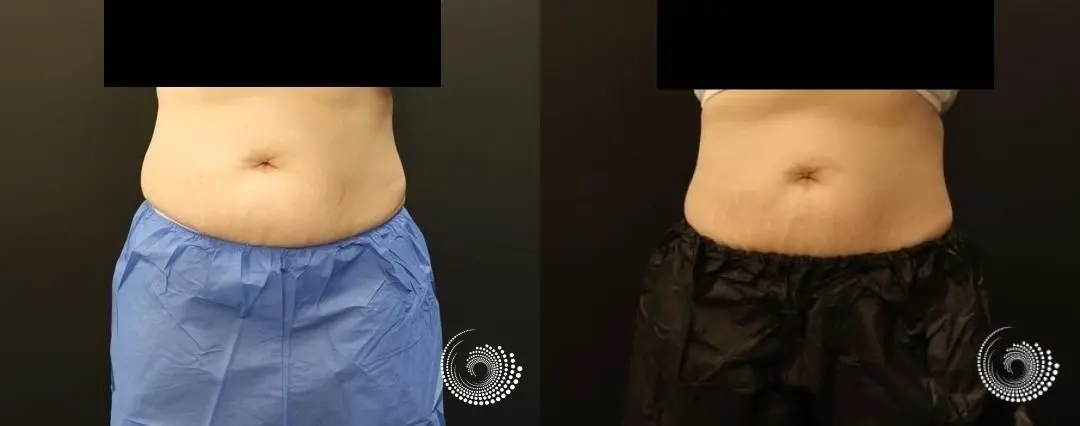 CoolSculpting reduces stubborn fat in abs and flanks - Before and After 2
