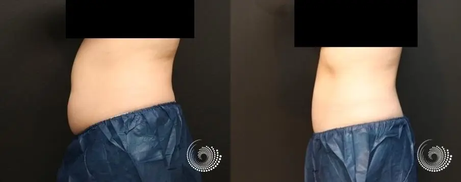 CoolSculpting Elite treatment – back, tummy, and side fat - Before and After 4