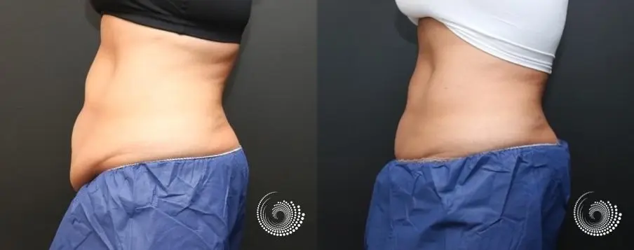 CoolSculpting Elite for her stubborn fat on abs and flanks - Before and After 3