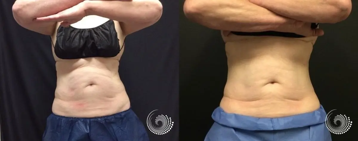 CoolSculpting Before and After 75