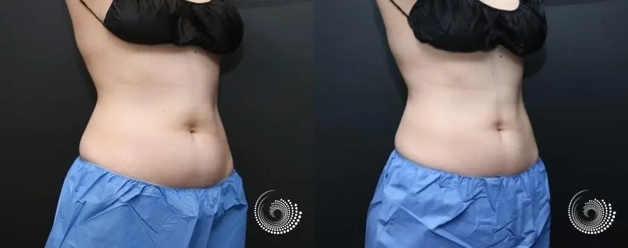 CoolSculpting Elite, reducing fat on tummy & flanks, before and after