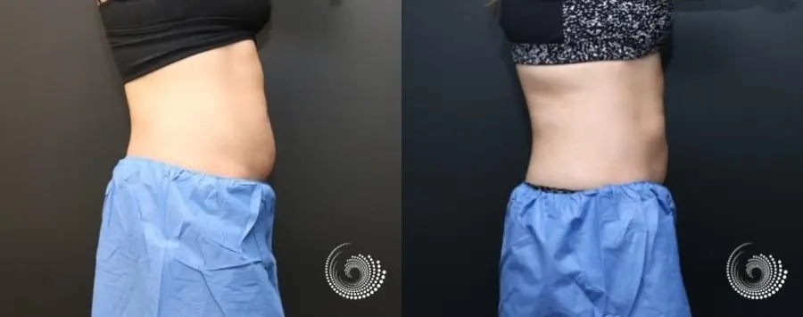 CoolSculpting Elite to reduce fat on abdominals - Before and After 4