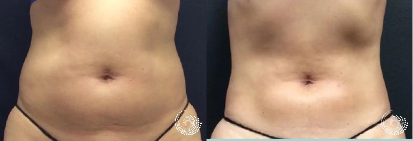 CoolSculpting Love Handles, Coolsculpting flanks before and after