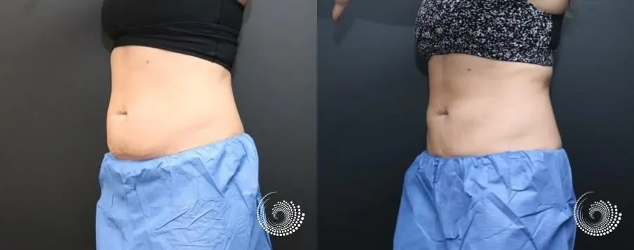 CoolSculpting Elite to reduce fat on abdominals - Before and After 2