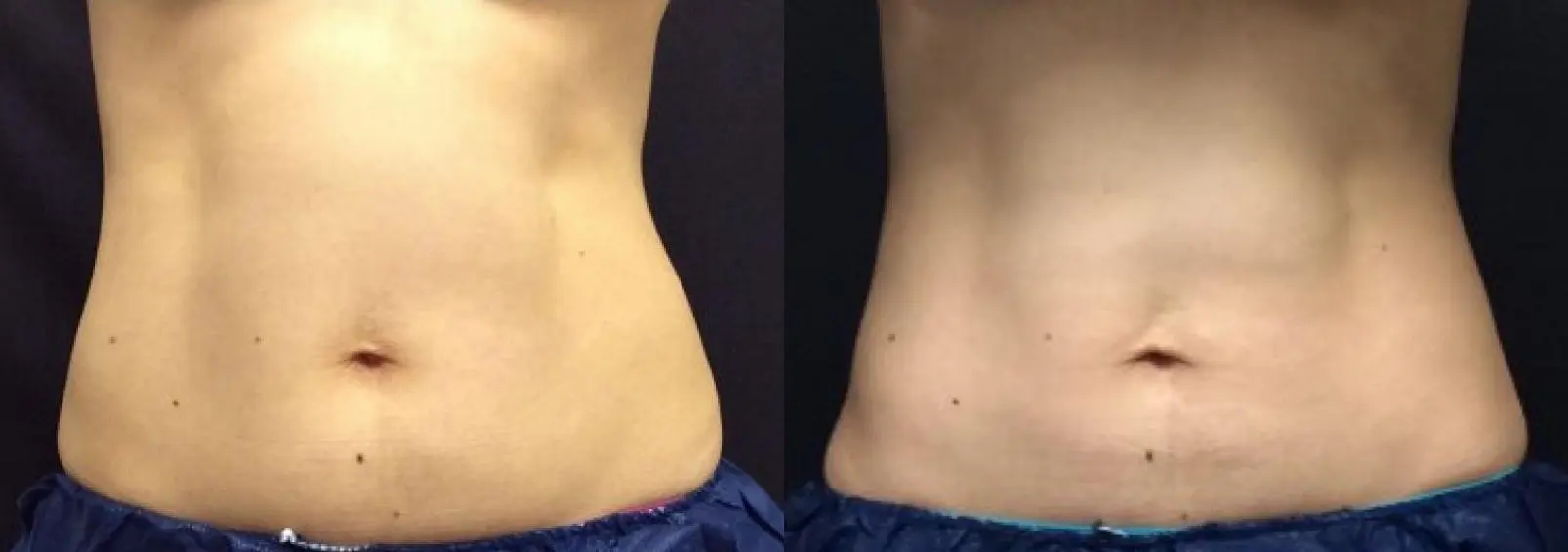 Sculpting a Smaller Waist with CoolSculpting Before & After Photos