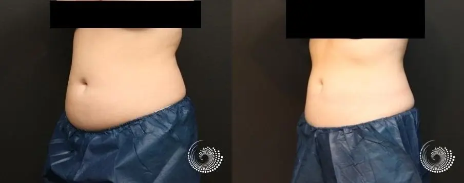 CoolSculpting Elite treatment – back, tummy, and side fat - Before and After 3