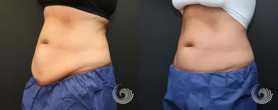 CoolSculpting Elite for her stubborn fat on abs and flanks - Before and After