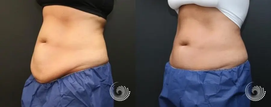 CoolSculpting Elite: Patient 2 - Before and After  