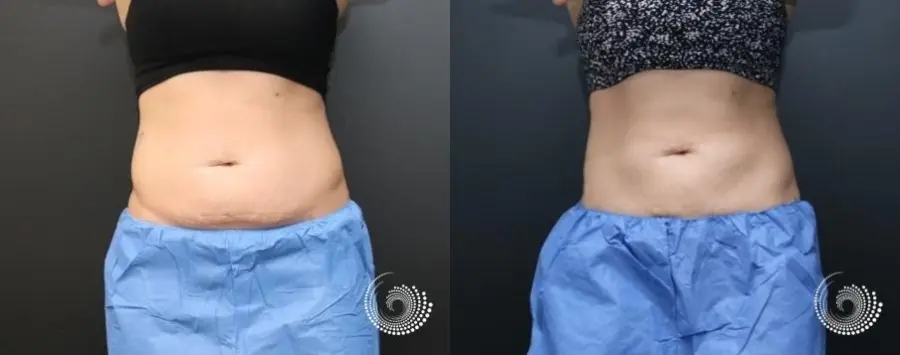 CoolSculpting Elite to reduce fat on abdominals - Before and After 1
