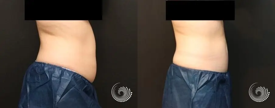 CoolSculpting Elite treatment – back, tummy, and side fat - Before and After 2