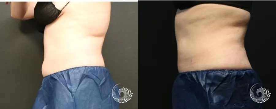 CoolSculpting Elite treatment - fat on flanks - Before and After 2