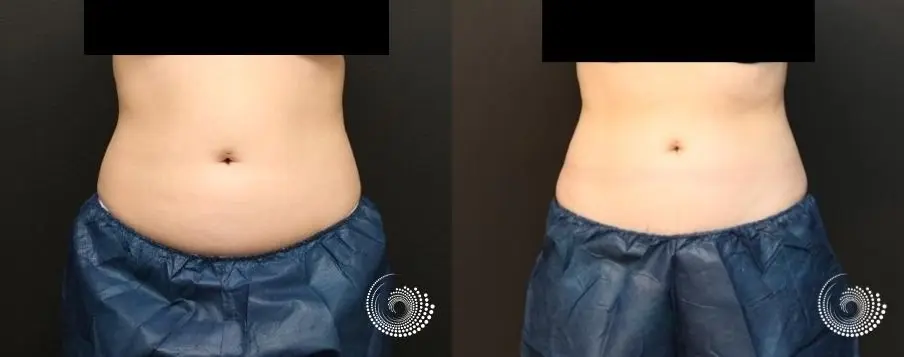 CoolSculpting Elite treatment – back, tummy, and side fat - Before and After 1