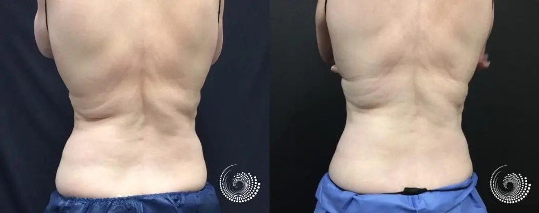 CoolSculpting - Upper & Lower Flanks Before & After Gallery - Case 4437